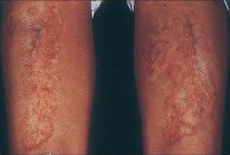 Erythematous Non Blanching Rash With Flakes On Both The Shins