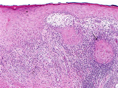 Hypertrophic Lichen Planus Mimicking Squamous Cell Carcinoma The