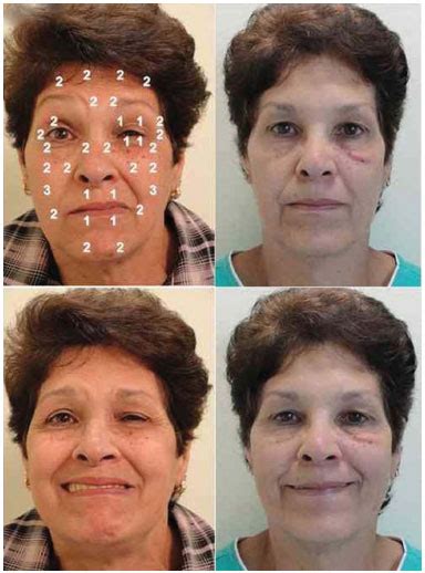 Rbcp Protocol For Bilateral Application Of Botulinum Toxin Type A To Avoid Asymmetry During