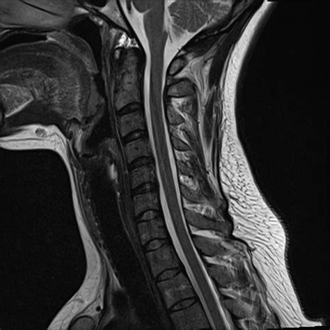 Normal Trauma Cervical Spine Mri Image Radiopaedia Org