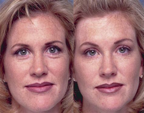Eyebrow Lift With Botox Before And After