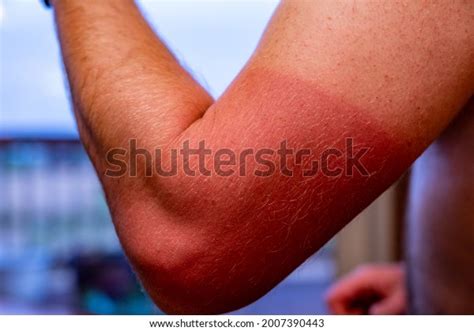 Arm Visible Red Sunburn Caused By Stock Photo 2007390443 Shutterstock