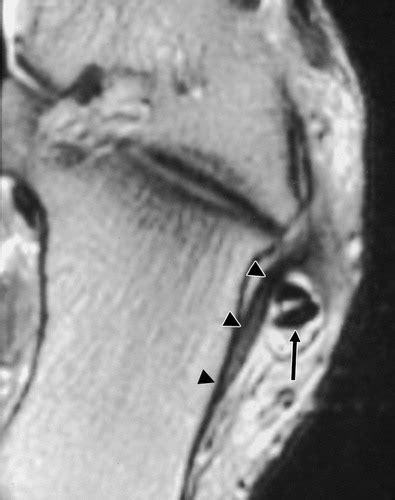 Mri Musculo Skeletal Section Peroneal Tendon Lesions