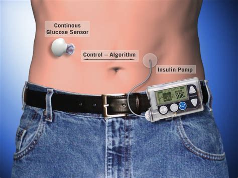 How An Artificial Pancreas Works Here And Now