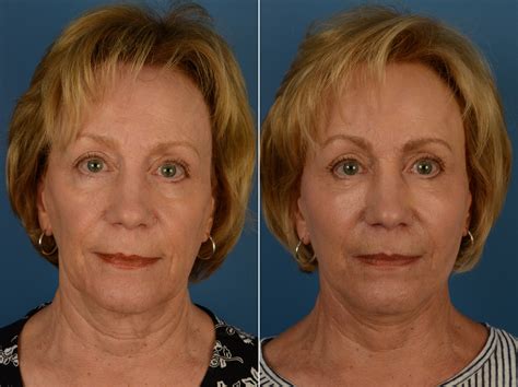 The Uplift™ Lower Face And Neck Lift Photos Naples Fl Patient 14422