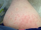 Pruritic Urticarial Papules and Plaques of Pregnancy (PUPPP Rash)