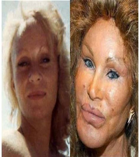 Of The Worst Celebrity Plastic Surgery Disasters