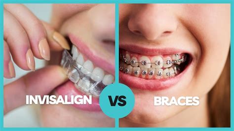 Invisalign Vs Braces Which Is Better South Point Dental Center