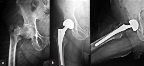 Preoperative Radiographs Of Right Hip Anteroposterior View Of