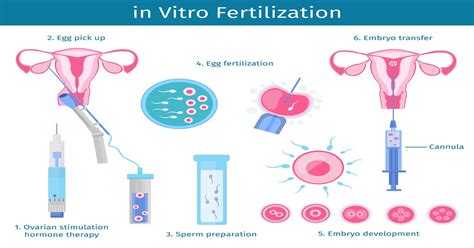 ivf procedure step by step ivf process start to finish