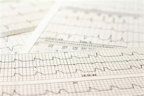 Electrocardiogram Strips With Cardiac Arrhythmias Acute Myocardial