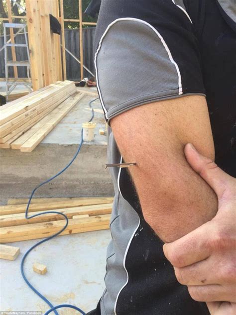 Australian Tradies Share Gruesome Photos Of Their Workplace Injuries