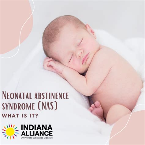 Neonatal Abstinence Syndrome Nas Indiana Alliance On Prenatal Substance Exposure
