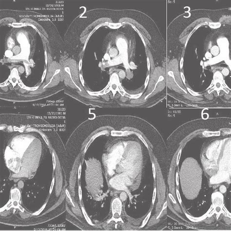 Ct Scan Angio Images At The Time Of Diagnosis And During The Treatment