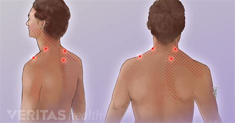 Trigger Point Exercises For Neck Pain