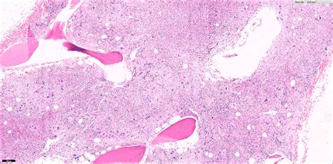 Pathology Outlines Acute Panmyelosis With Myelofibrosis