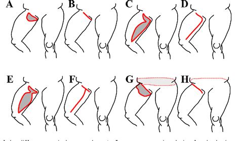 Medial Thighplasty Current Concepts And Practices Semantic Scholar