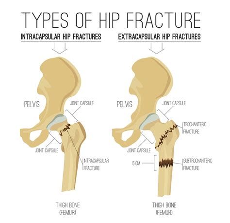 Hip Fracture Recovery Timeline Encompass Health