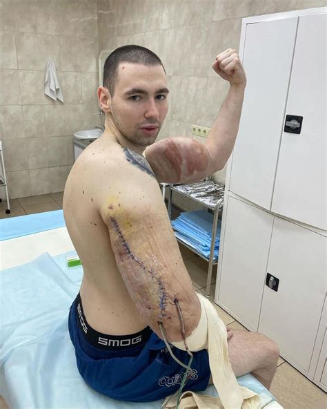 Russian Popeye Who Injected Triceps With OIL Has Life Saving Surgery