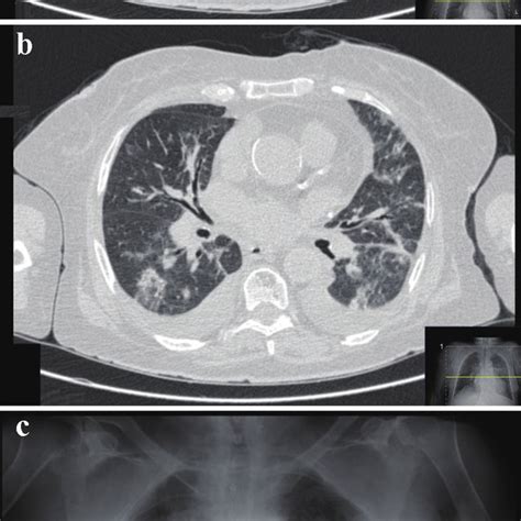 Thorax Ct Scan A B And Chest X Ray C Showing Bilateral Diffuse