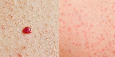 These Pictures Show Exactly What Those Annoying Spots On Your Skin