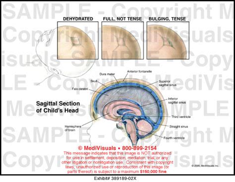 Medivisuals States Of The Anterior Fontanelle Medical Illustration