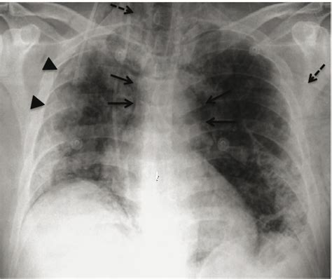 Scielo Brasil Pneumomediastinum And Subcutaneous Emph