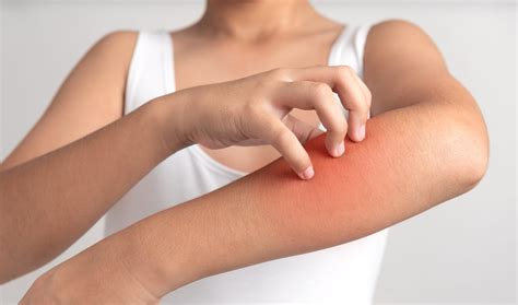 Urticaria A Common Skin Condition Resulting In Itchy Hives Allergy
