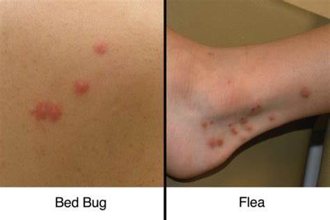 Bed Bug Vs Flea Bites