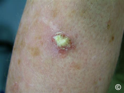 Squamous Cell Carcinoma On Arm