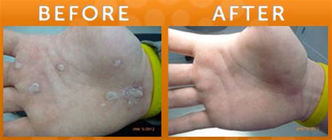 Laser Treatment For Warts In New Jersey