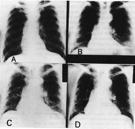 Figure 3 From Lung Involvement In Systemic Sclerosis Sine Scleroderma