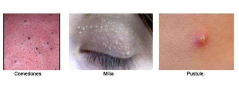 Extractions Comedones Milia And Pustules Oh My Adair™ Skin Care