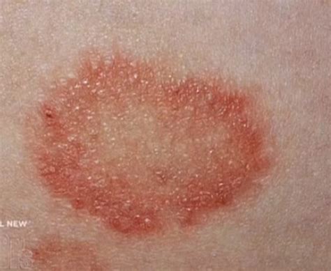 Stress Rash Causes Symptoms Pictures And Treatment