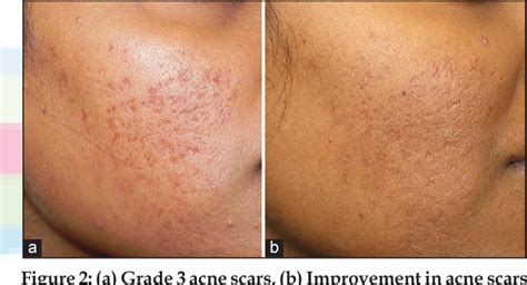 Pdf Evaluation Of Microneedling Fractional Radiofrequency Device For