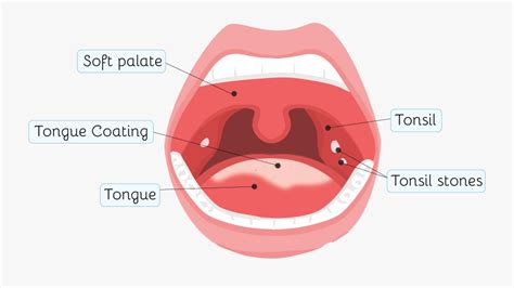 Clip Art Tonsillitis And Tonsil Stones Immune System Tonsils Free