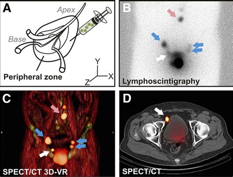 Sentinel Lymph Node Biopsy For Prostate Cancer A Hybrid Approach Journal Of Nuclear Medicine