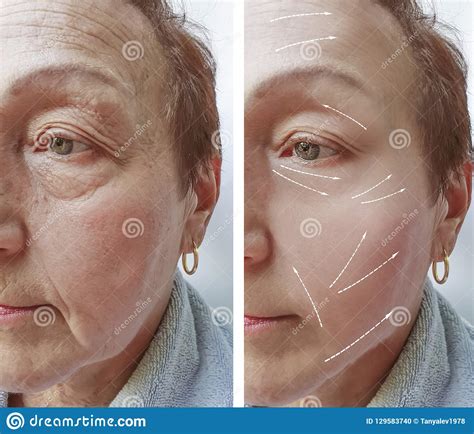 Elderly Woman Wrinkles On Face Therapy Results Cosmetology Before And
