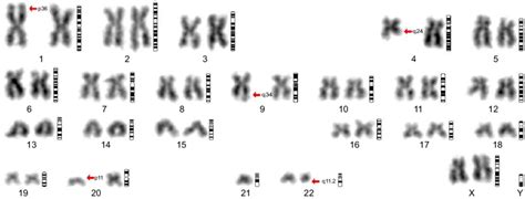 Cytogenetic Analysis Notes Chromosome Analysis By G Banding Showing A Download Scientific