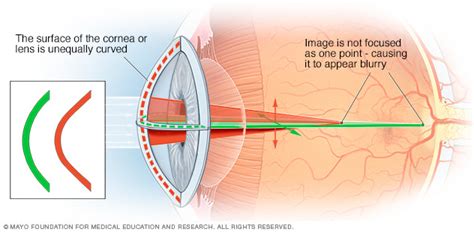 Astigmatism Diagrams Astigmatism Glaucoma Swollen Eyes Disease Fff