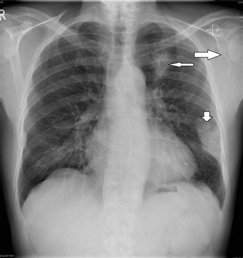It projects upwards, above the level of the 1st rib and into the floor of the neck. A 59 year old male with metastatic non small cell lung ...