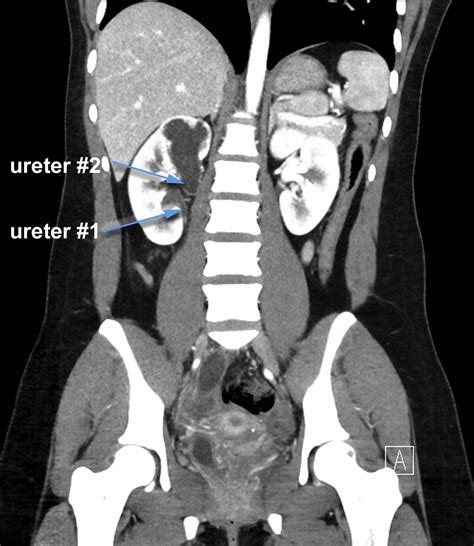 Duplicated Or Ectopic Renal Collecting System In Two Adult Emergency