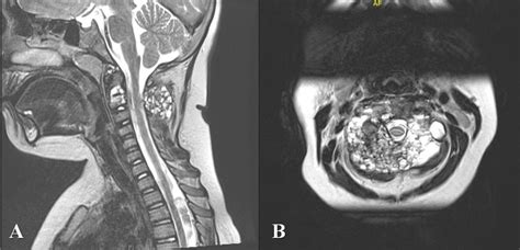 Aneurysmal Bone Cyst In The Cervical Spine Bmj Case Reports