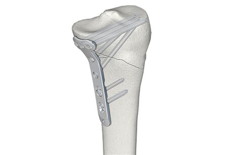 Lcp Medial Proximal Tibia Plate 45 Depuy Synthes Jandj Medtech Emea