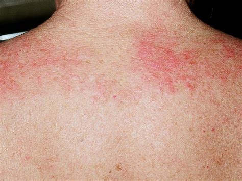 Spot Dx — What Is Causing This Pruritic Rash With Associated Weakness