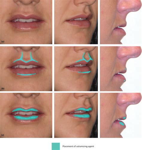 6 Lip And Perioral Cosmetic Surgery Pocket Dentistry