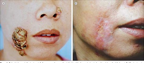 Figure 1 From Granulomatous Skin Infection Caused By Malassezia