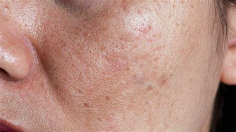 How To Deal With Acne And Pigmentation For Combination Skin Dark Spots