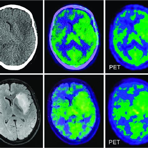 Petct And Petmri Images Of 56 Y Old Patient With Glioblastoma