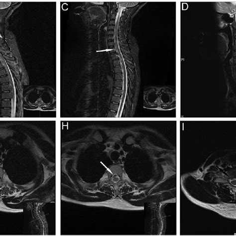 MRI Showing Thoracic Left And Lumbar Right Subdural Hematomas